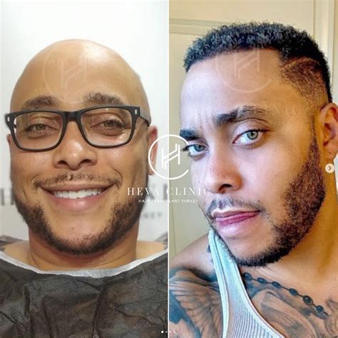 Hair Transplant in Philippines • Check Prices & Reviews.
